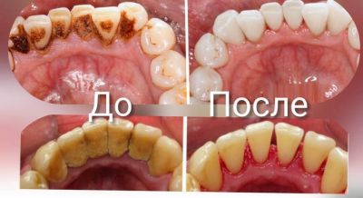 До и после чистки зубов от зубного камня