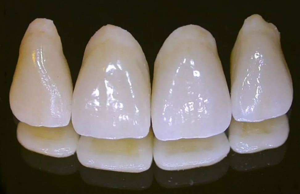 Керамические зубы на передние зубы фото